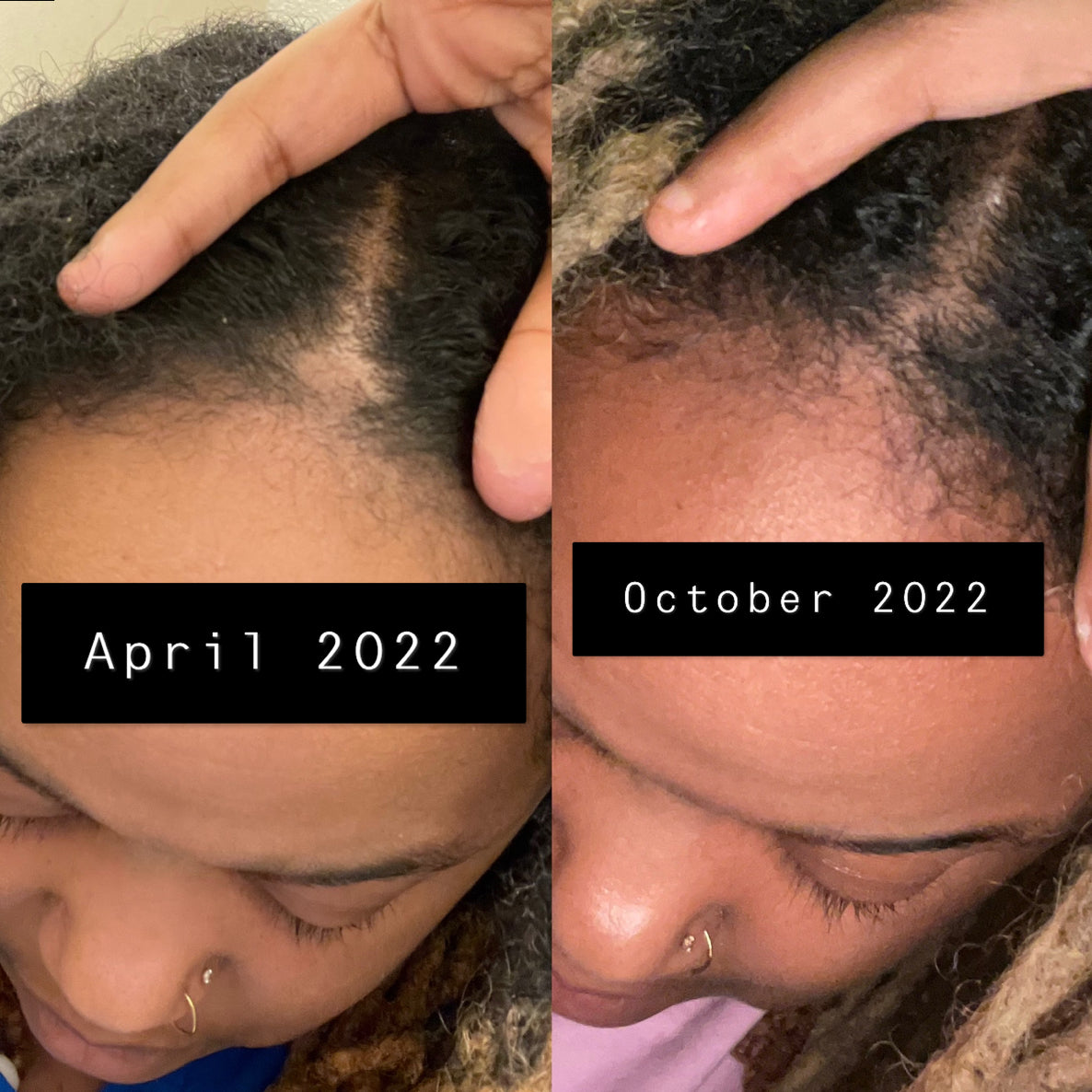 Hair growth 